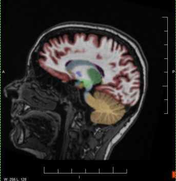 MRI Screenshot